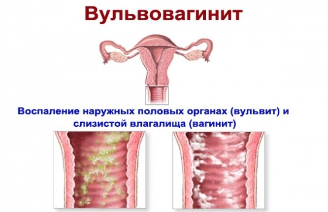 Кандидозный вульвит симптомы