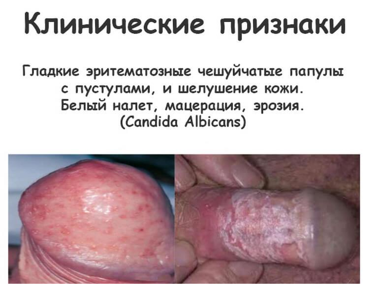 кандидоз на половом члене